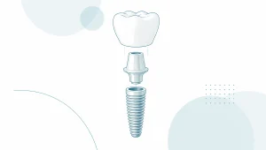 A separated dental implant crown, abutment and fixture float in a clean white space.