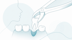 When Teeth Removal May Be the Best Treatment Option - Main Image